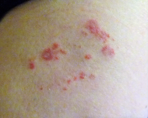 Bedbug bites are distinctive and are an indication of an infestation. Make sure to call a bedbug exterminator.