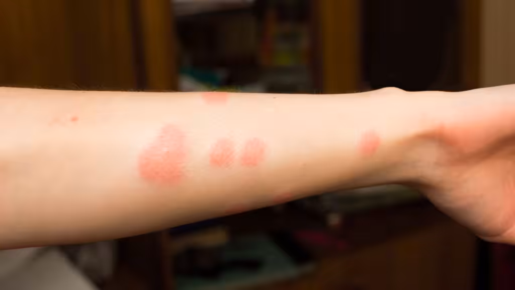 Flea bites are small, intensely itchy, and almost always grouped.