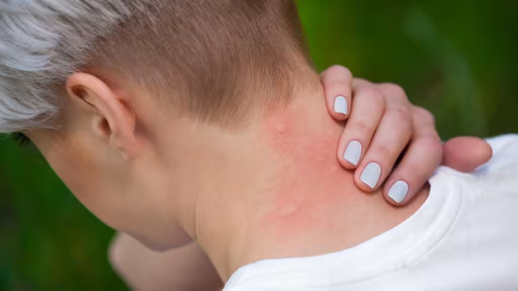 Mosquito bites appear as soft, rounded welts that show up shortly after exposure.