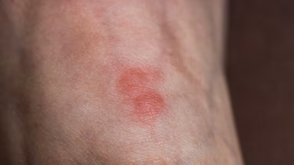 Ant bite that is inflamed and red