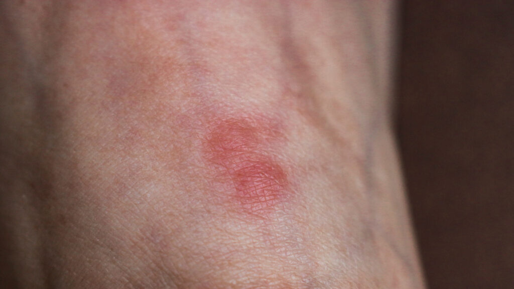 Ant bite that is inflamed and red
