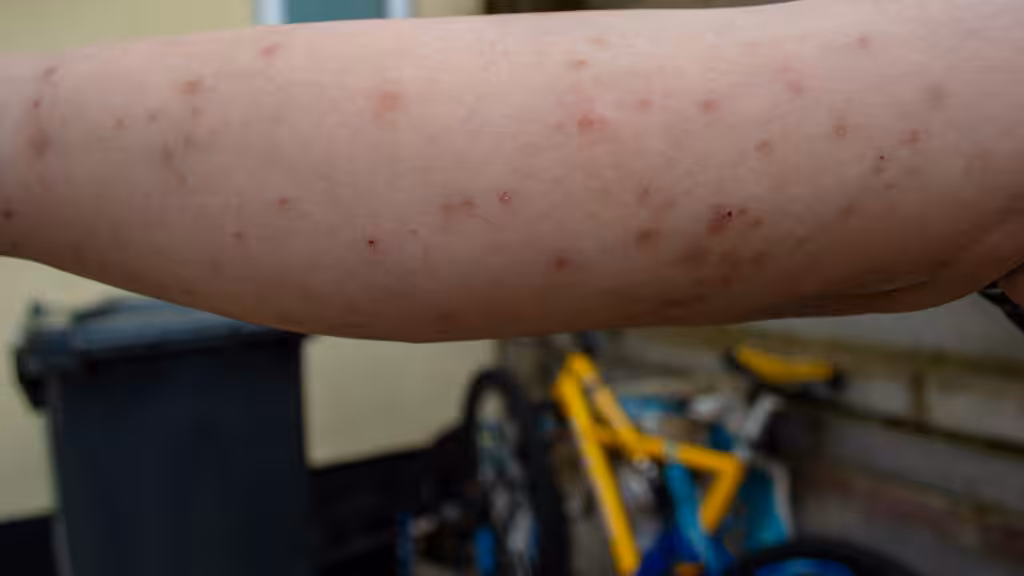 Bed bug bites